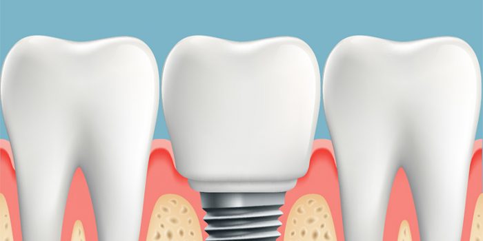 info about dental implants