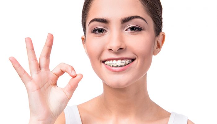 woman with white clear ceramic braces